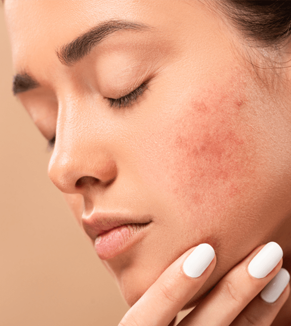Acne laser treatment - Tushe laser clinic London